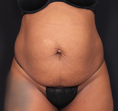 New Jersey Tummy Tuck Before & After Gallery - Patient 263049 - Image 1