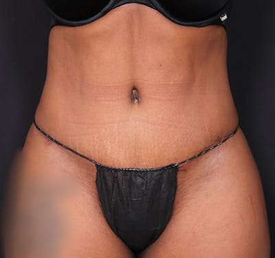 New Jersey Tummy Tuck Before & After Gallery - Patient 263049 - Image 2