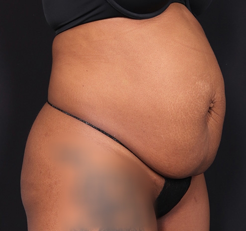 New Jersey Tummy Tuck Before & After Gallery - Patient 263049 - Image 3
