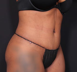 New Jersey Tummy Tuck Before & After Gallery - Patient 263049 - Image 4