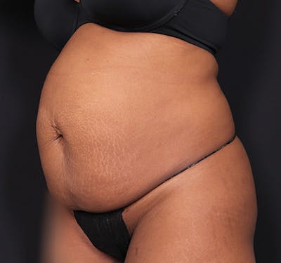 New Jersey Tummy Tuck Before & After Gallery - Patient 263049 - Image 5