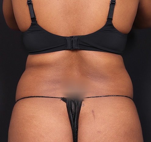 New Jersey Tummy Tuck Before & After Gallery - Patient 263049 - Image 7