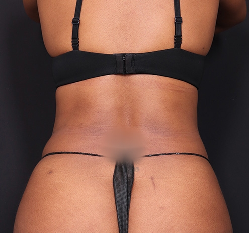 New Jersey Tummy Tuck Before & After Gallery - Patient 263049 - Image 8