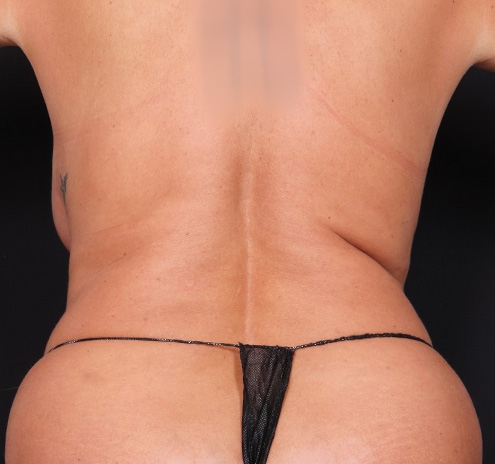 New Jersey Tummy Tuck Before & After Gallery - Patient 385862 - Image 7