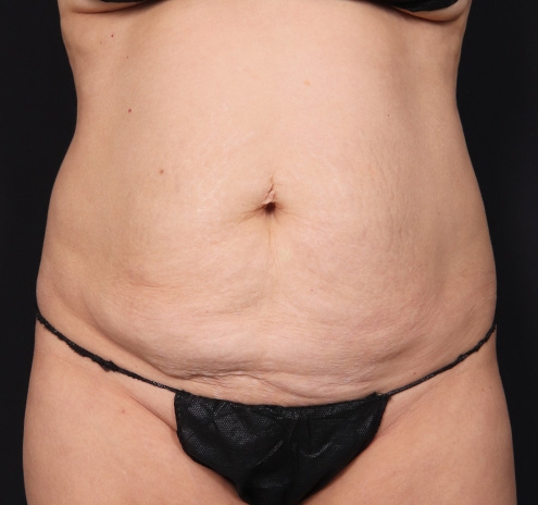 New Jersey Tummy Tuck Before & After Gallery - Patient 103408 - Image 1