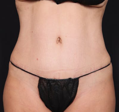 New Jersey Tummy Tuck Before & After Gallery - Patient 103408 - Image 2