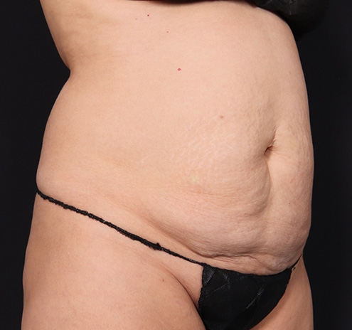 New Jersey Tummy Tuck Before & After Gallery - Patient 103408 - Image 3