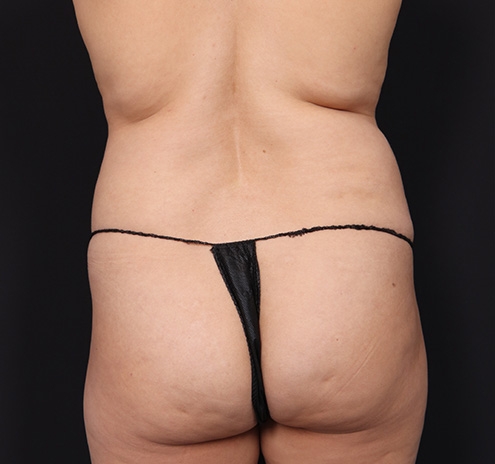 New Jersey Tummy Tuck Before & After Gallery - Patient 103408 - Image 7