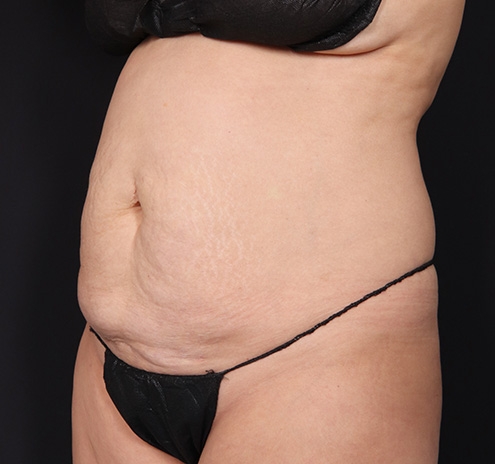 New Jersey Tummy Tuck Before & After Gallery - Patient 103408 - Image 9