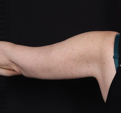 New Jersey Brachioplasty Before & After Gallery - Patient 220631 - Image 2