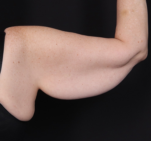 New Jersey Brachioplasty Before & After Gallery - Patient 220631 - Image 5
