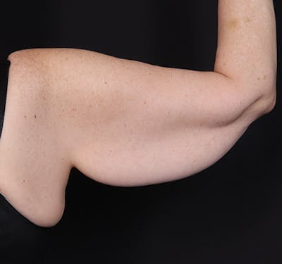 New Jersey Brachioplasty Before & After Gallery - Patient 220631 - Image 5