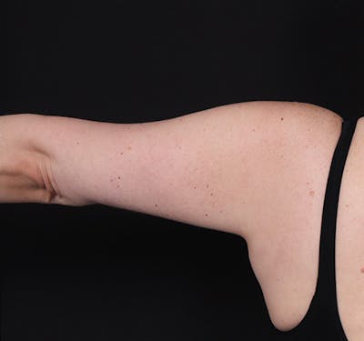 New Jersey Brachioplasty Before & After Gallery - Patient 210133 - Image 2