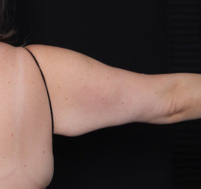 New Jersey Brachioplasty Before & After Gallery - Patient 210133 - Image 3