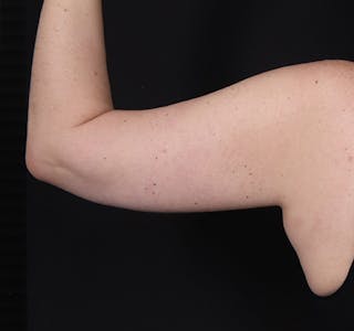 New Jersey Brachioplasty Before & After Gallery - Patient 210133 - Image 6