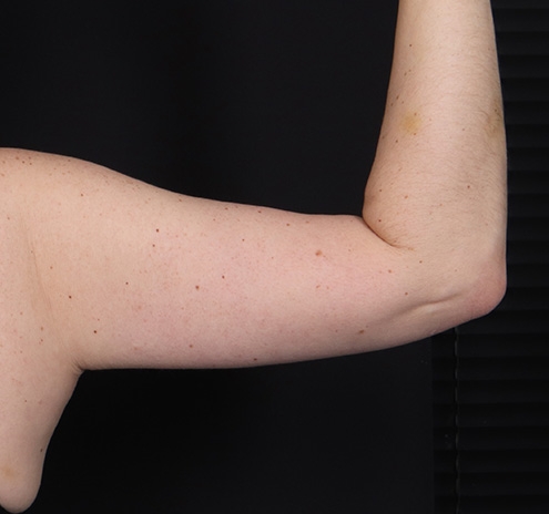 New Jersey Brachioplasty Before & After Gallery - Patient 210133 - Image 8