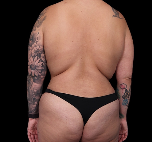 New Jersey Back Lift Before & After Gallery - Patient 135790 - Image 1