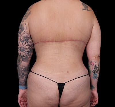 New Jersey Back Lift Before & After Gallery - Patient 135790 - Image 2