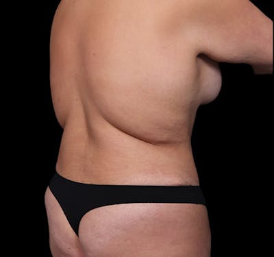 New Jersey Back Lift Before & After Gallery - Patient 135790 - Image 3