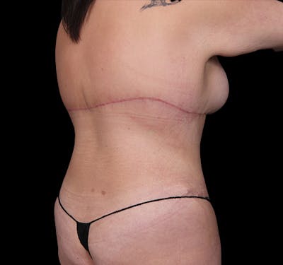 New Jersey Back Lift Before & After Gallery - Patient 135790 - Image 4