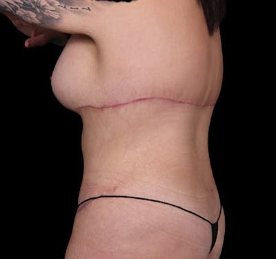 New Jersey Back Lift Before & After Gallery - Patient 135790 - Image 6
