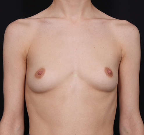 New Jersey Breast Augmentation Before & After Gallery - Patient 113140 - Image 1