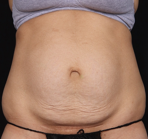 New Jersey Tummy Tuck Before & After Gallery - Patient 150662 - Image 1