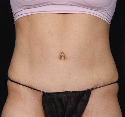 New Jersey Tummy Tuck Before & After Gallery - Patient 150662 - Image 2