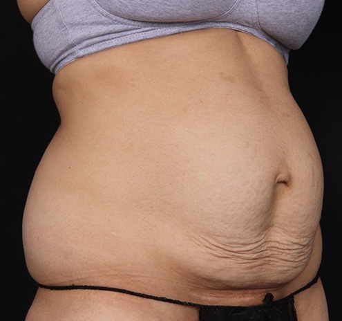 New Jersey Tummy Tuck Before & After Gallery - Patient 150662 - Image 3