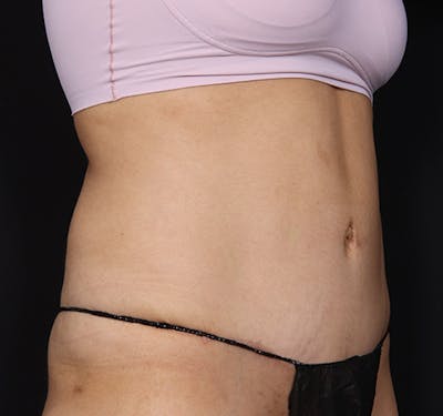 New Jersey Tummy Tuck Before & After Gallery - Patient 150662 - Image 4
