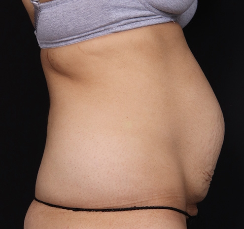 New Jersey Tummy Tuck Before & After Gallery - Patient 150662 - Image 5
