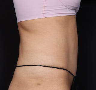 New Jersey Tummy Tuck Before & After Gallery - Patient 150662 - Image 6