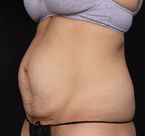 New Jersey Tummy Tuck Before & After Gallery - Patient 150662 - Image 7