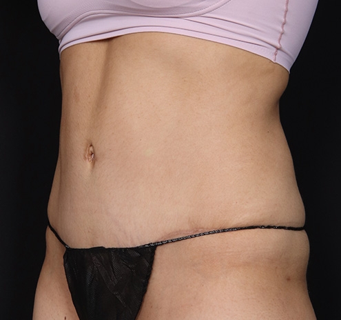 New Jersey Tummy Tuck Before & After Gallery - Patient 150662 - Image 8