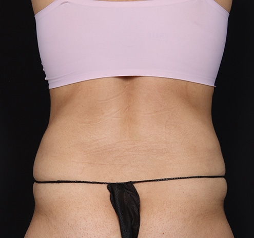 New Jersey Tummy Tuck Before & After Gallery - Patient 150662 - Image 10