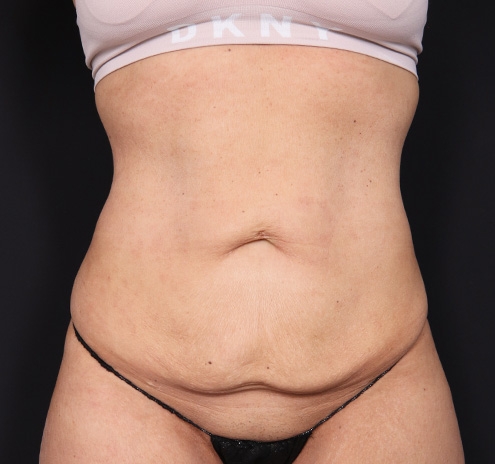 New Jersey Tummy Tuck Before & After Gallery - Patient 260049 - Image 1