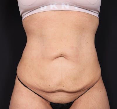 New Jersey Tummy Tuck Before & After Gallery - Patient 260049 - Image 1
