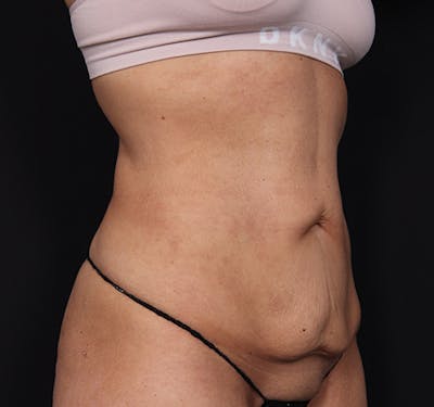 New Jersey Tummy Tuck Before & After Gallery - Patient 260049 - Image 3