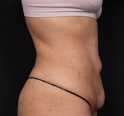 New Jersey Tummy Tuck Before & After Gallery - Patient 260049 - Image 5
