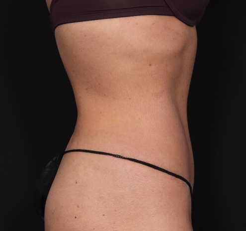 New Jersey Tummy Tuck Before & After Gallery - Patient 260049 - Image 6