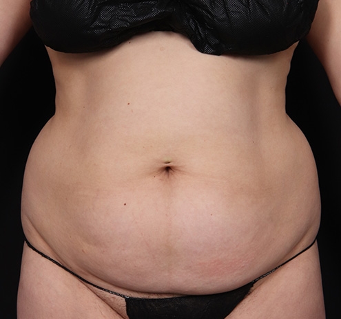 New Jersey Tummy Tuck Before & After Gallery - Patient 195792 - Image 1
