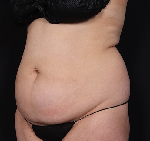 New Jersey Tummy Tuck Before & After Gallery - Patient 195792 - Image 5