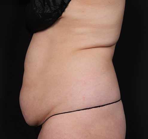 New Jersey Tummy Tuck Before & After Gallery - Patient 195792 - Image 7