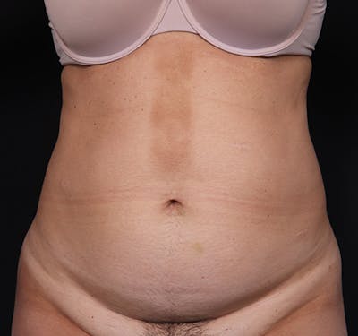 New Jersey Tummy Tuck Before & After Gallery - Patient 123006 - Image 1