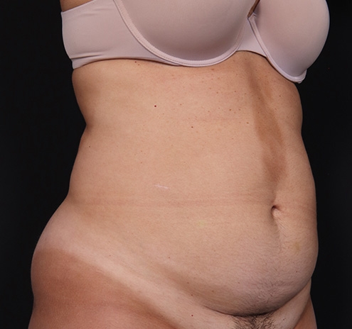 New Jersey Tummy Tuck Before & After Gallery - Patient 123006 - Image 3