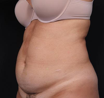 New Jersey Tummy Tuck Before & After Gallery - Patient 123006 - Image 5
