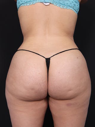 New Jersey Buttock/Hip Fat Grafting Before & After Gallery - Patient 313134 - Image 2