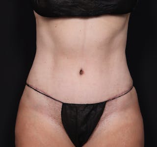 New Jersey Tummy Tuck Before & After Gallery - Patient 181785768 - Image 2