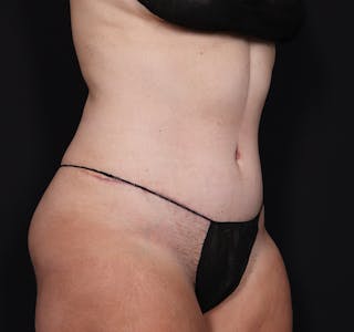 New Jersey Tummy Tuck Before & After Gallery - Patient 181785768 - Image 8