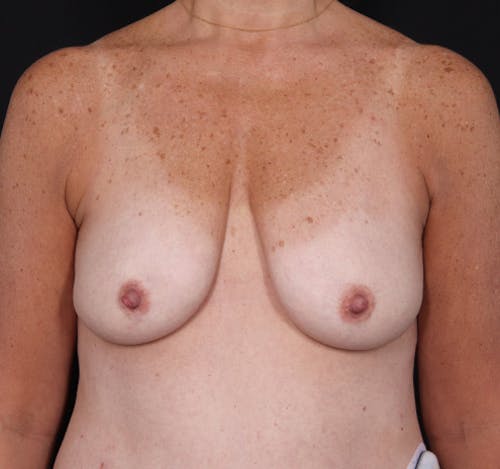 New Jersey Breast Lift (Mastopexy) Before & After Gallery - Patient ev3Qs6BuRR-oynbrj_byLQ - Image 1